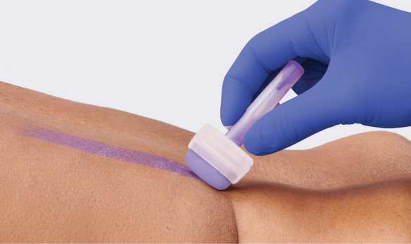 Clinician applies skin protectant to patient’s back, leaving behind a purple barrier to fight skin breakdown