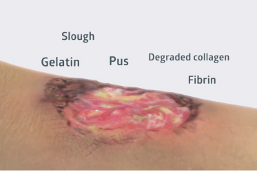 Iodine dressing turns white to indicate time for removal and peels back from wound
