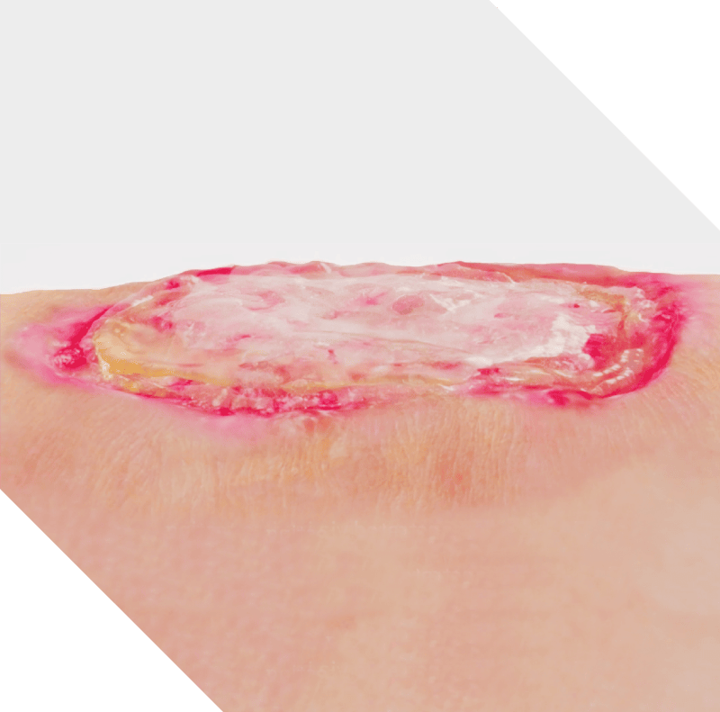 An infected wound that shows biofilm formation