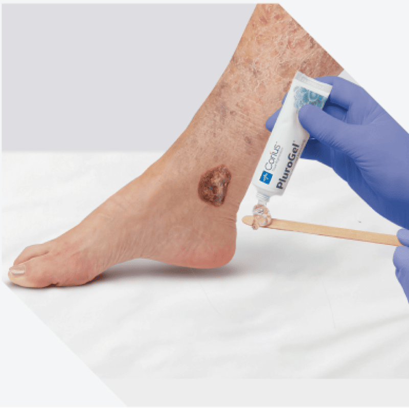 Clinician applies a chronic wound care product to treat patient’s non-healing wound with biofilm