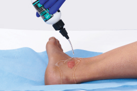Clinician’s gloved hand applies dressing with antimicrobial agents to a wound with biofilm infection