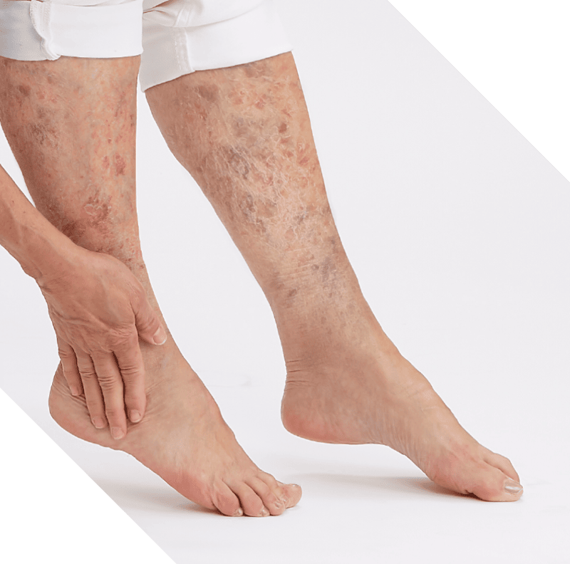 Patient touches leg, showing visible signs of venous stasis disease