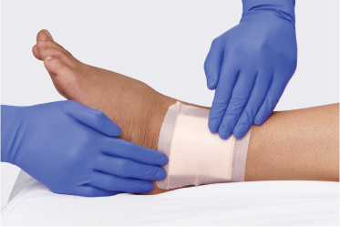 Clinician’s gloved hands apply a moisture wicking wound dressing to patient’s arm