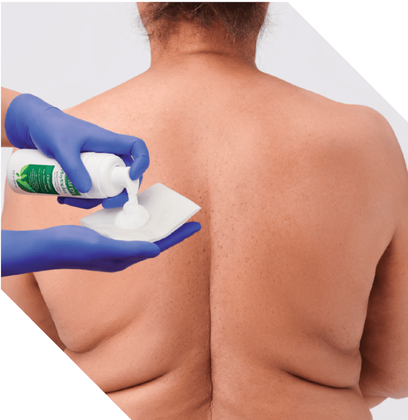 Clinician’s gloved hand applies Marathon XL to patient’s skin with wide applicator