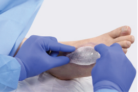 Clinician’s gloved hands, applying tissue regeneration dressing to patient wound