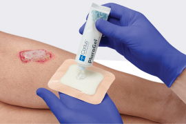 Clinician’s gloved hands, applying concentrated surfactant gel dressing to patient wound