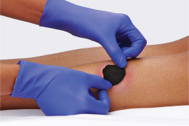 Clinician’s gloved hands, applying iodine dressing to patient wound