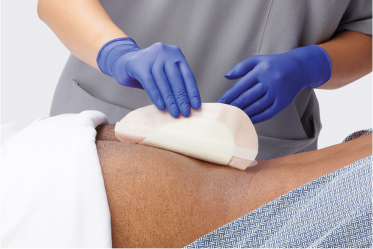 Gloved caregiver and bare leg of patient as caregiver dispenses foam on to cleansing cloth.