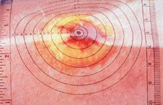 STK_ALI70831_PRI01_326x210_RGB Tracing sheet measuring a wound