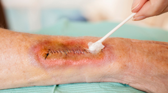 Wound being swabbed