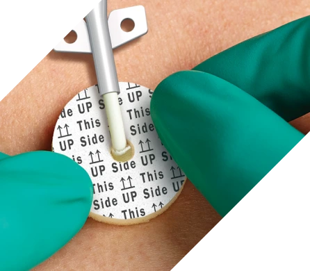 AEGIS CHG impregnated foam disc being placed by gloved fingers