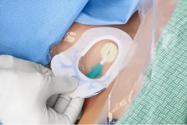 SorbaView SHIELD CVC dressing and securement device on a patient.