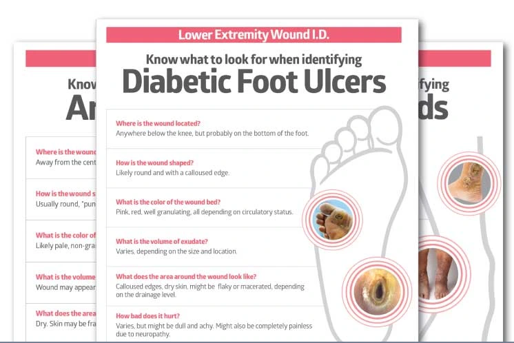 Know what to look for when identifying diabetic foot ulcers