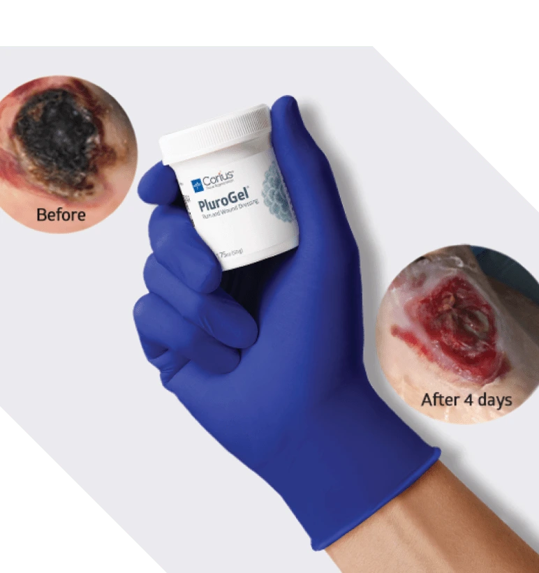 PluroGel Burn and Wound Dressing