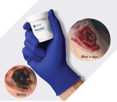 PluroGel Burn and Wound Dressing