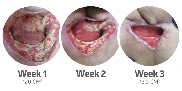 plurogel-case-study-2-min Surgical dehiscence on wound photo