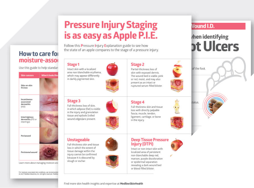 Wound care posters on pressure injury staging, MASD, and foot ulcers.