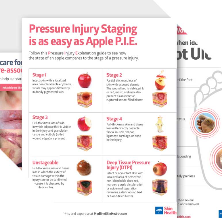 Wound care posters on pressure injury staging, MASD, and foot ulcers.