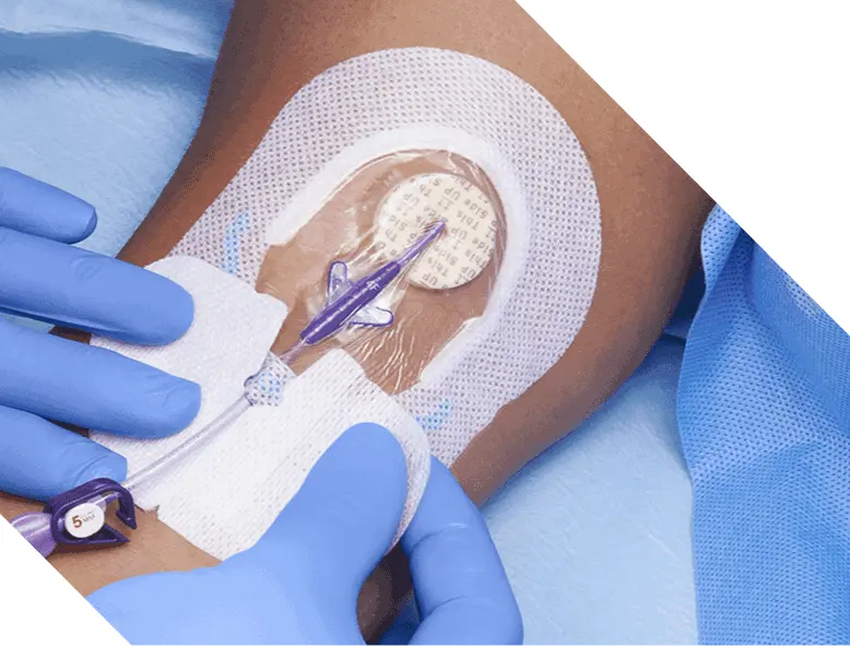 A clinician secures the catheter hub in SorbaView SHIELD device she’s put on a patient’s arm. 