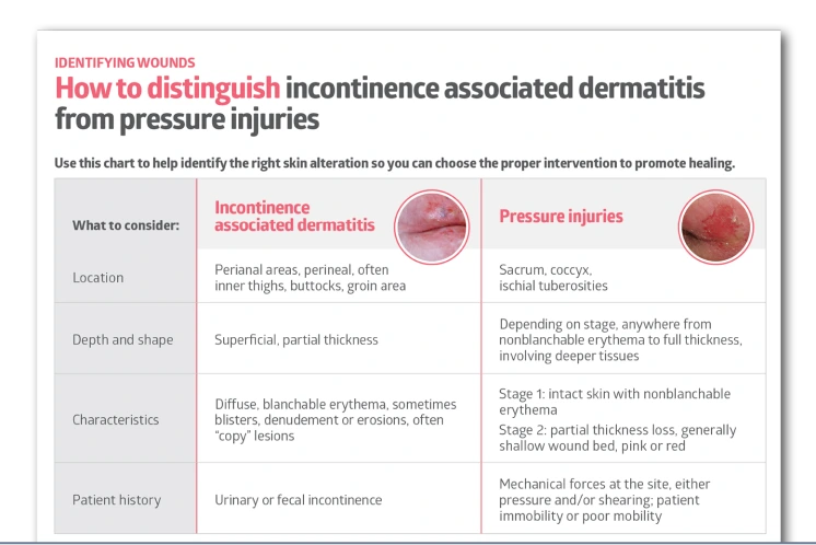 How to distinguish incontinence associated dermatitis from pressure injuries