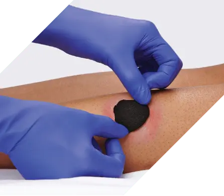 Clinician’s gloved hands apply iodine dressing that’s cut to size to an infected wound Iodine dressing for biofilm management