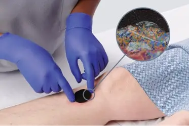 product_benefits_image2 Clinicians places wound dressing with microscopic view of polyvinyl foam Polyvinyl foam dressing