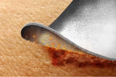 IoPlex dressing turned white peels away from wound White IoPlex dressing
