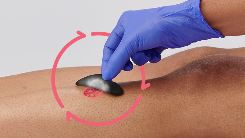 Clinician applies a dressing with iodine for wounds to patient's open leg wound.