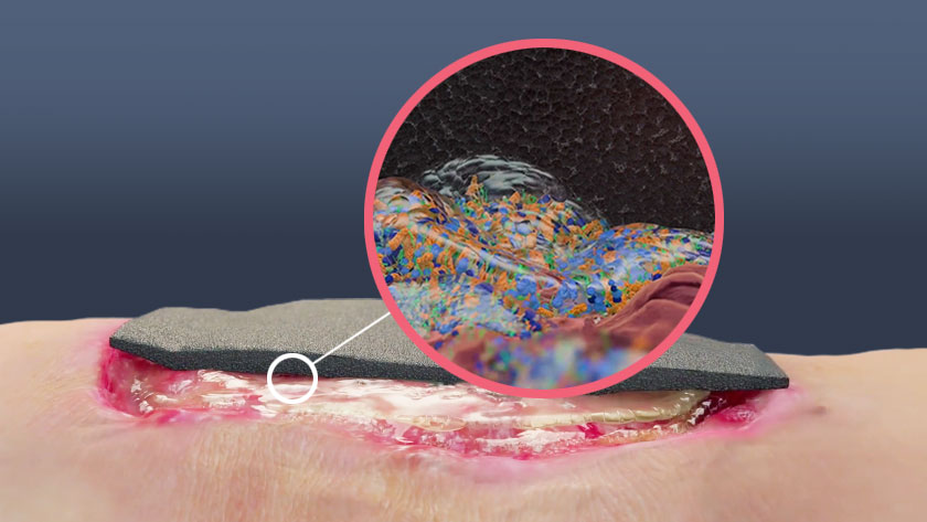 Iodine dressing sits atop infected wound with circular callout to show microscopic view.