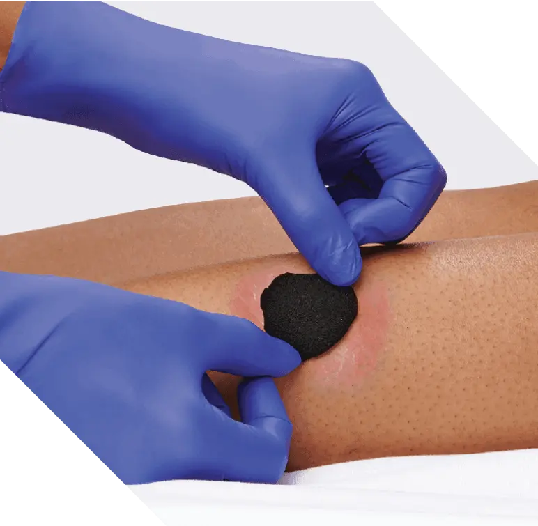 Clinician’s gloved hands apply iodine dressing that’s cut to size to an infected wound Iodine dressing for biofilm management