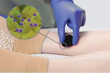 product_benefits_image1_updated Clinician applies IoPlex dressing with microscopic view of iodine being released in wound Slow release iodine