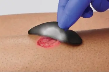 product_benefits_image3_updated Clinician cuts iodine dressing to size of open leg wound Cut-to-size dressing