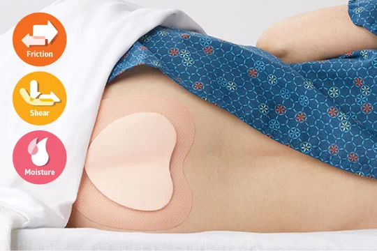 Sacral-foam-dressing Patient lies on side with a sacral foam dressing applied to lower back