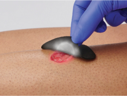 manage-infection Gloved hand holding IoPlex dressing over small wound