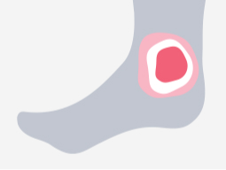 unhealed-VLU Illustration of foot with wound