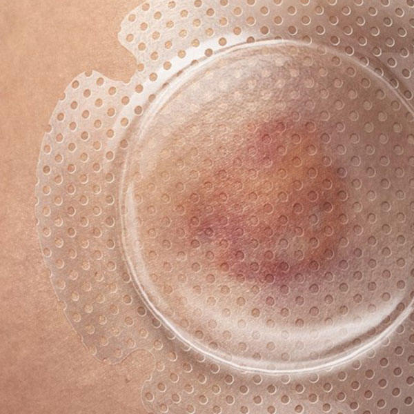 STK_Optiview_Round_in-us_RGB Prophylactic transparent dressing placed over at-risk skin