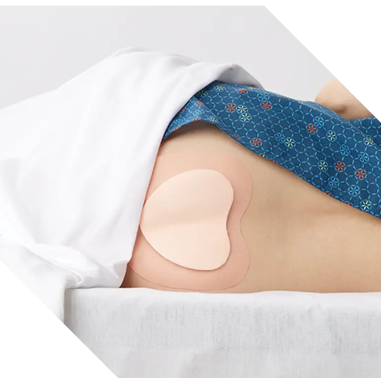 Patient lies on side with bordered foam dressing over the sacral area