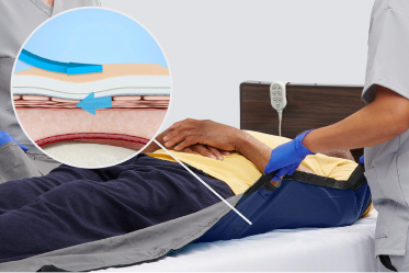 optifoam_product_benefits_image1 Caregivers reposition bedridden patient using a glide sheet with diagram to show absorption of friction and shear
