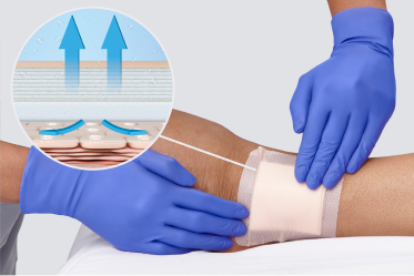 optifoam_product_benefits_image2 Clinician applies dressing to limb with callout to show moisture being wicked away