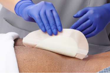 optifoam_product_benefits_image3 Clinician pulls away dressing from patient’s sacral area