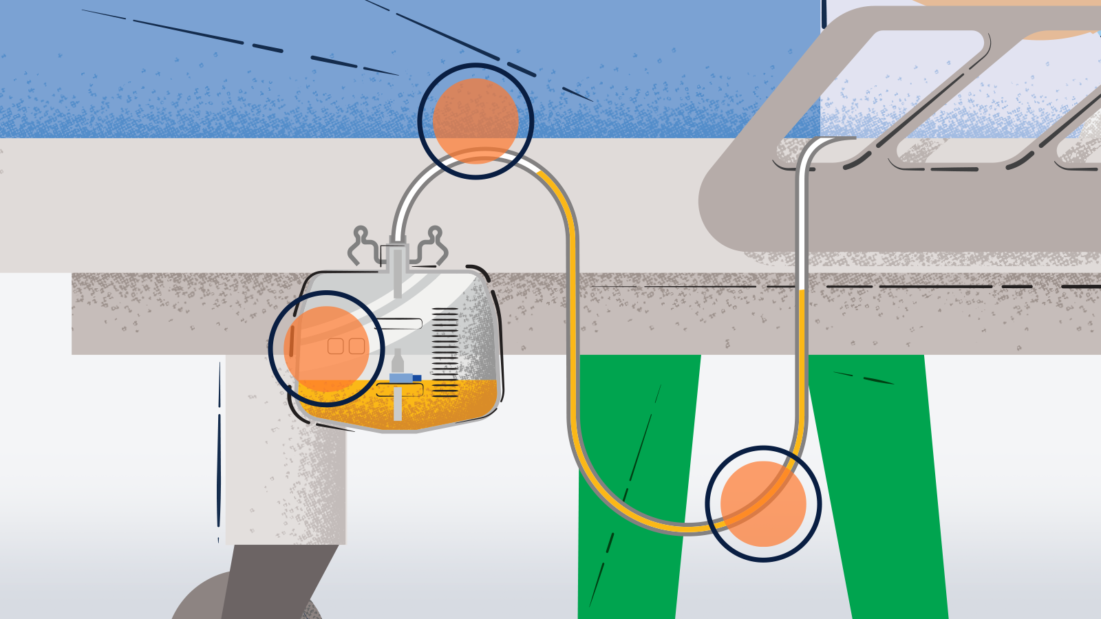 BAN_IP_URO infographic_RGB Errors in setting up an intermittent urinary catheter