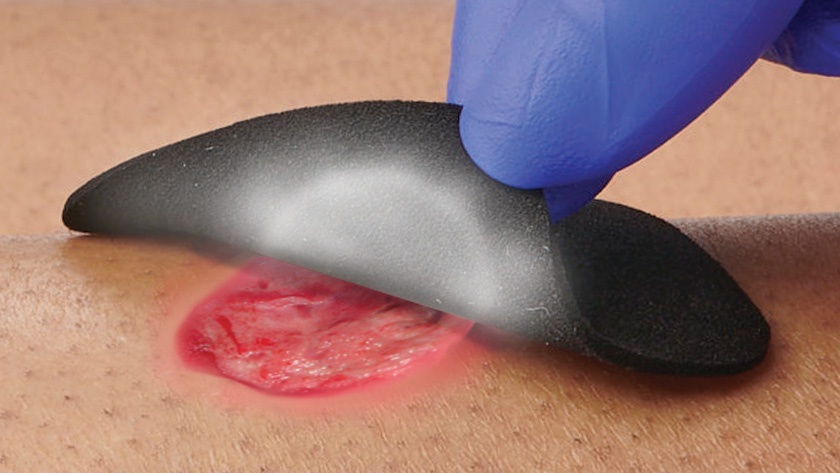Close-up showing wound and IoPlex as it changes from black to white when used