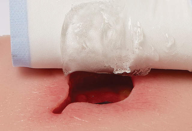 PAP_PluroGel_application_1_RGB PluroGel being applied to a wound