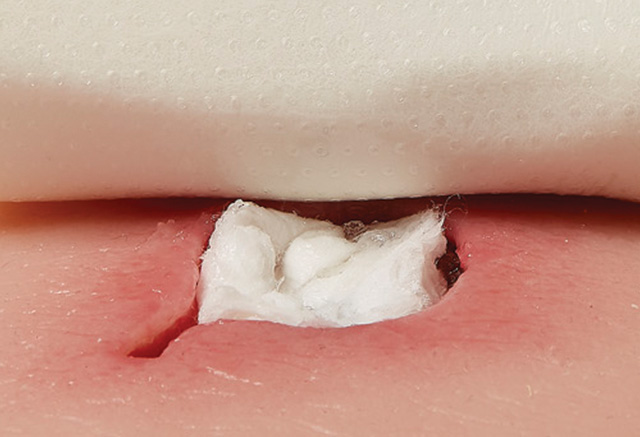 PAP_PluroGel_application_2_RGB Wound packed with a packing strip with PluroGel