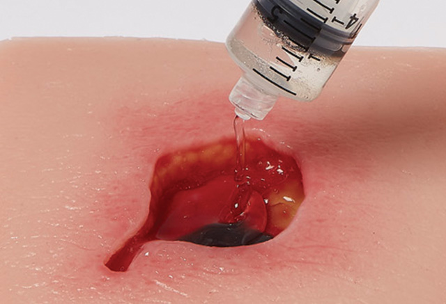 PAP_PluroGel_application_3_RGB Liquefied version of PluroGel being applied to a wound