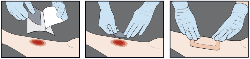 Clinician taking IoPlex Iodophor foam dressing out of package. Clinician applying IoPlex after it's cut to size. Clinician covering IoPlex with appropriate secondary dressing