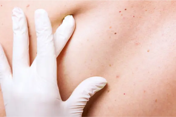 Clinician blanches patient skin with gloved hand