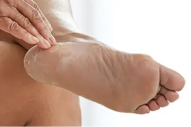 dry-cracked-skin Hand examines dry, flaking skin on heel