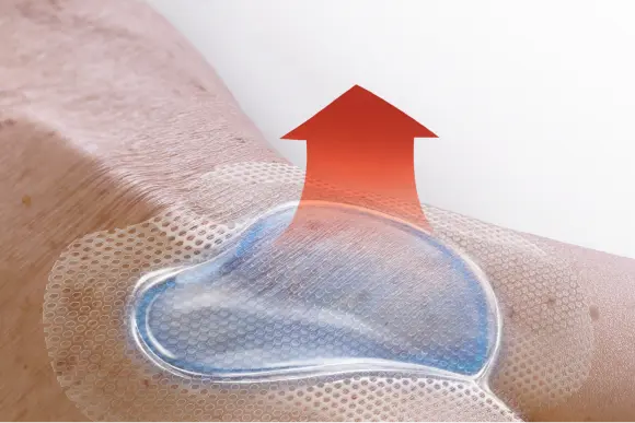 micro-climate OptiView dressing applied to patient’s sacrum with red arrow to show heat being pulled away from the skin