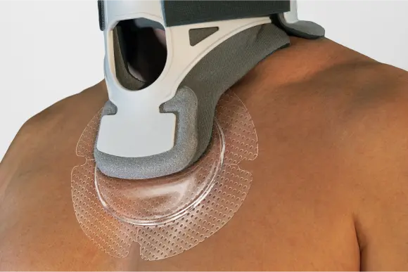 pressure-injuries Dressing underneath patient’s neck brace to manage pressure and shear from device
